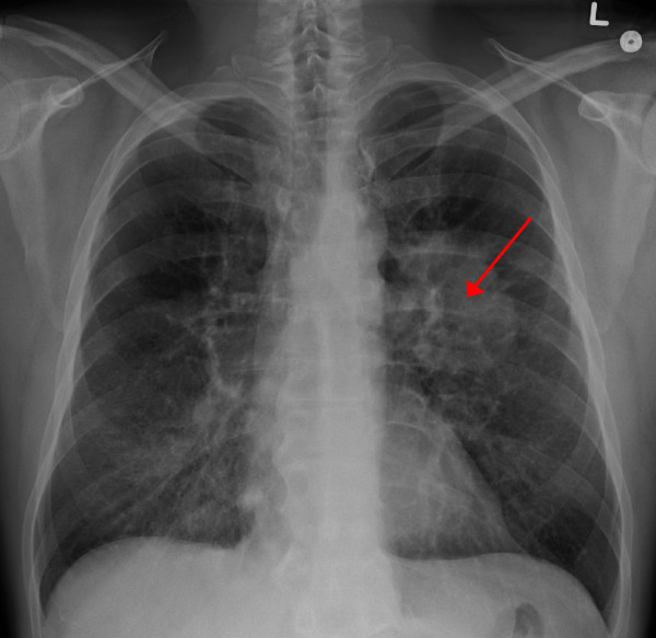 Cáncer de pulmón
